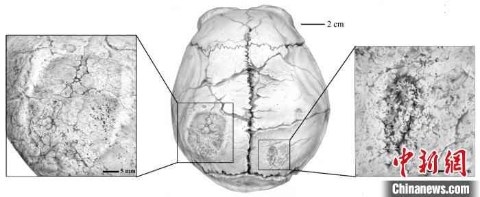 和县直立人头骨后部创伤痕迹。(郭肖聪 供图)