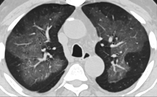 中、下肺轴位CT平扫显示毛玻璃样混浊伴胸膜下保留。(同一病人CT影像)