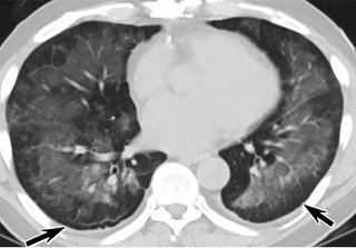 中、下肺轴位CT平扫显示毛玻璃样混浊伴胸膜下保留(箭头)。(同一病人CT影像)