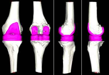广东首例AI辅助全膝关节置换手术,手术过后就能走